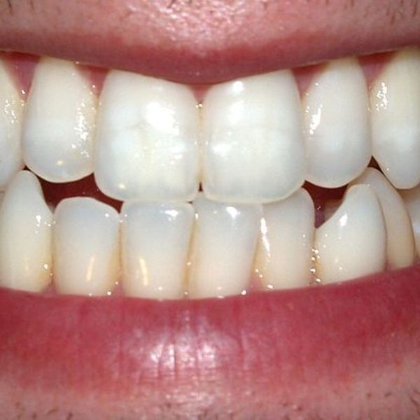Dents denture bouche
