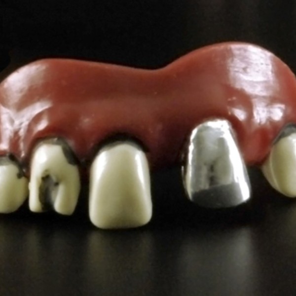 Dentier partie du haut 1 dent en argent et 1 dent eclatee