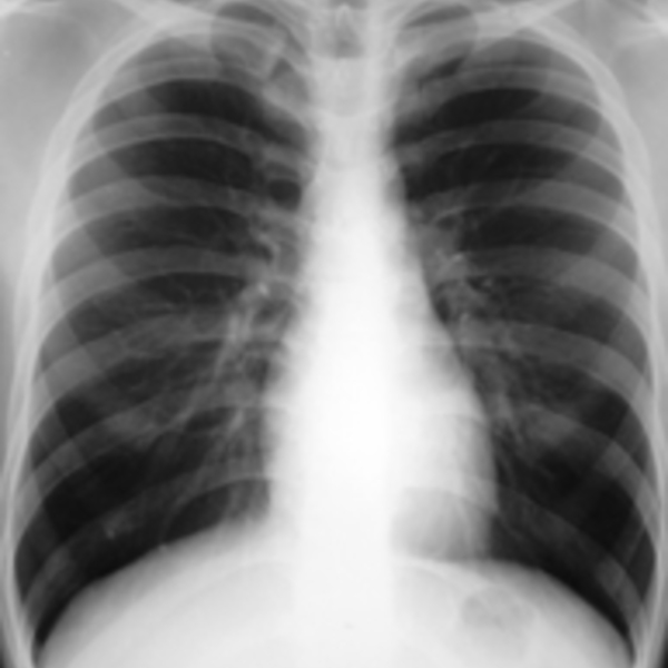 5.2.10 chest x ray