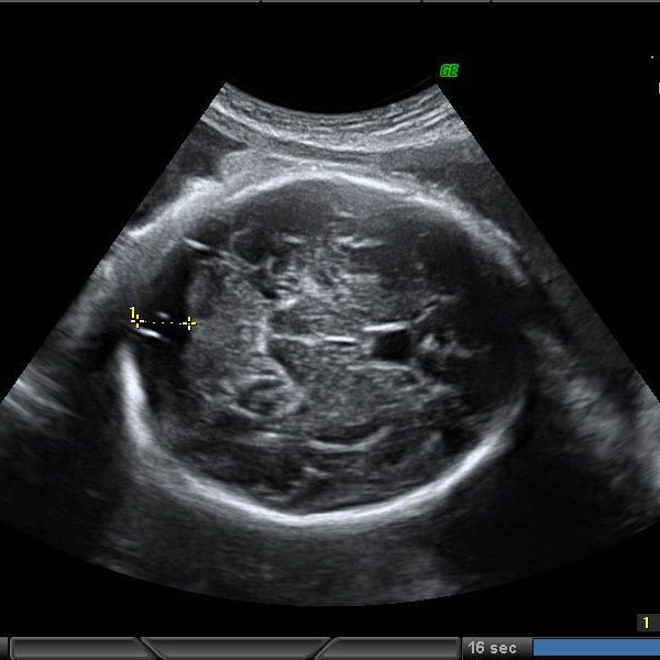 Anatomy of kidney ultrasound images fetal br on geoface